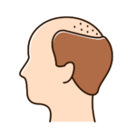 脱发 Hair loss