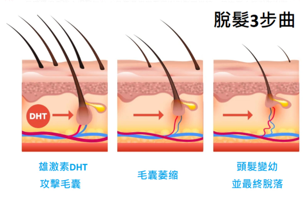 雄性激素脱发原理